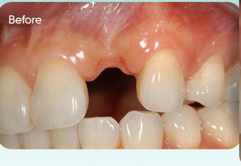 Abdullah's smile before treatment
