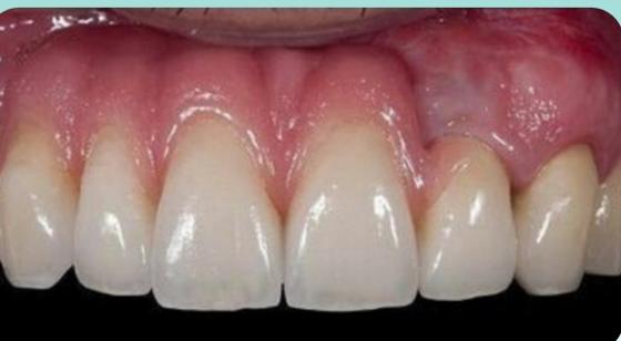 Frank's smile after treatment