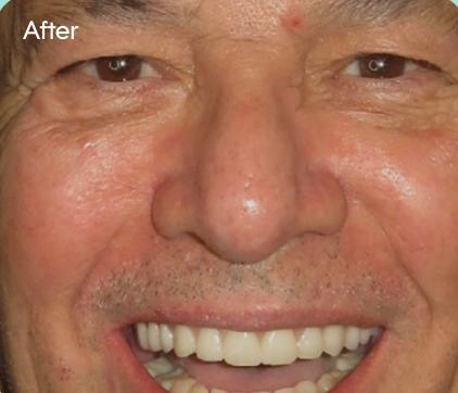 Luis's smile after treatment