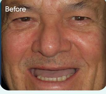 Luis's smile before treatment