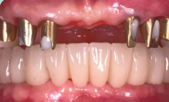 Marcelle's smile before treatment