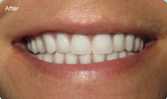 Maribeth's smile after treatment