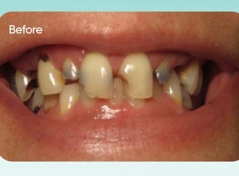 Maribeth's smile before treatment