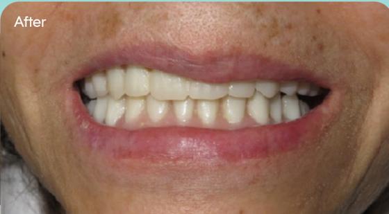 Ms. Martha's smile after treatment