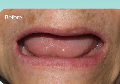Ms. Martha's smile before treatment