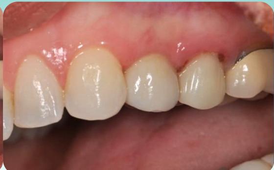Melisa's smile after treatment