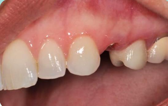 Melisa's smile before treatment
