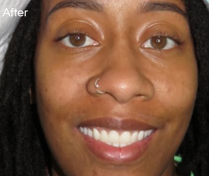 The patient's smile after treatment