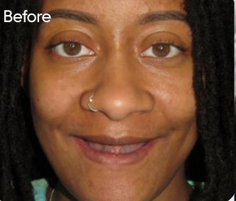 The patient's smile before treatment
