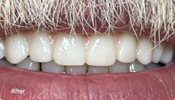 Paul's smile after treatment