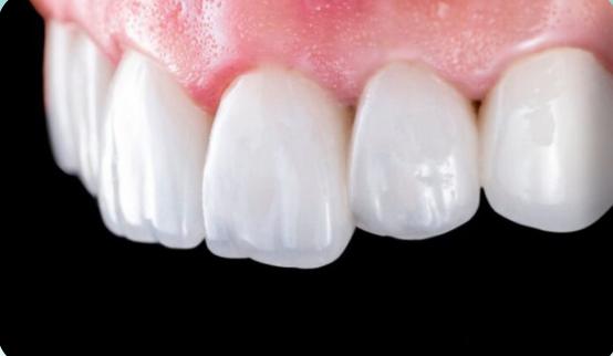 Pierre's smile before treatment